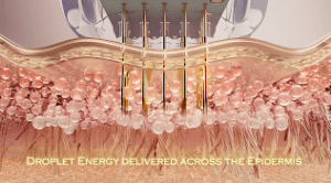 Illustration showing golden rods delivering energy droplets across layers of the skin, with text at the bottom reading, "Droplet Energy delivered across the Epidermis.