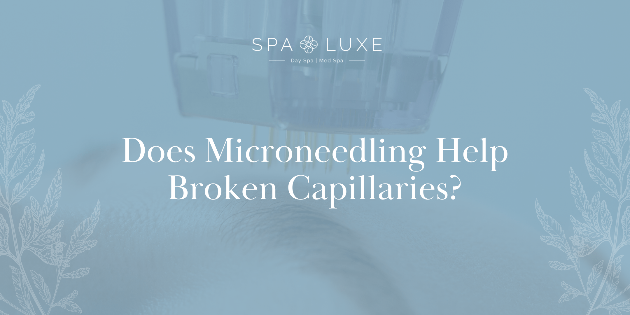Spa Luxe article header: Does Microneedling Help Broken Capillaries? on a blue banner with leaf borders.